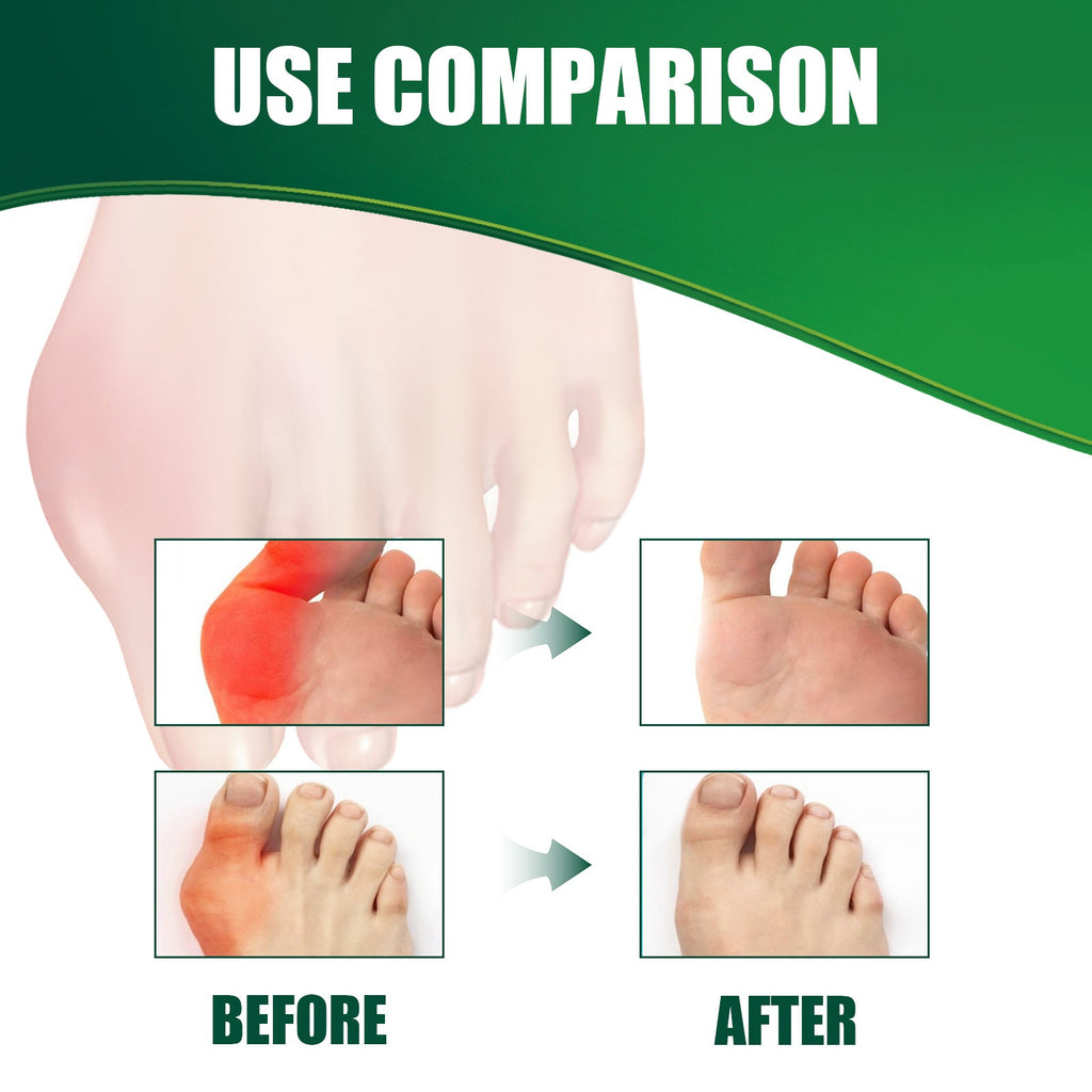 Bunion Relief Patch Thumb Valgus Bigfoot Bunion Valgus Double Toe Foot Care Patch